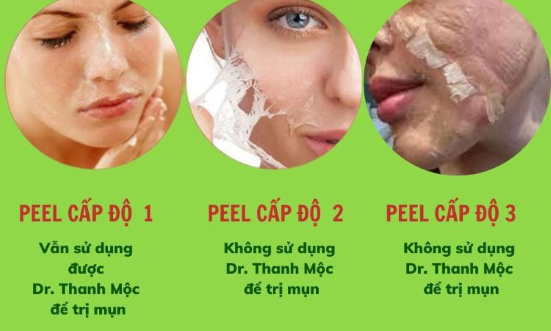Các Cấp Độ Peel Da