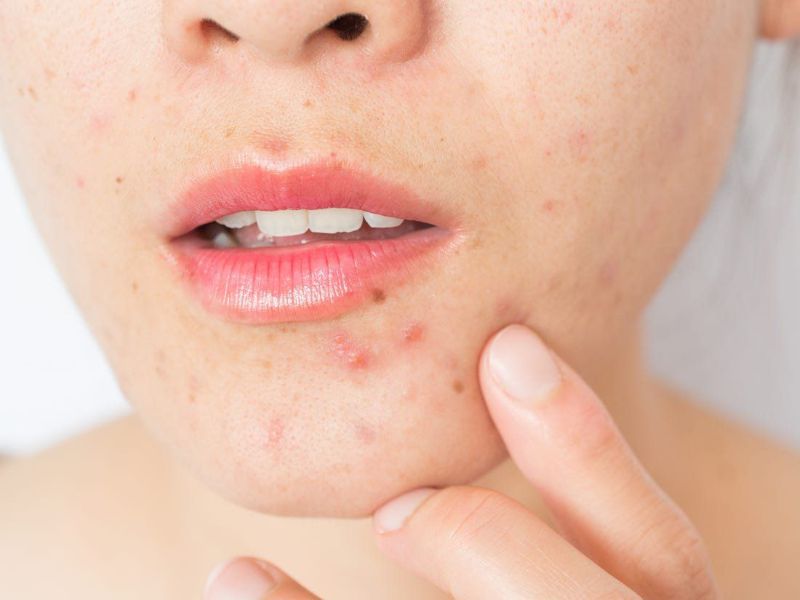 Các phương pháp điều trị mụn nội tiết hiệu quả