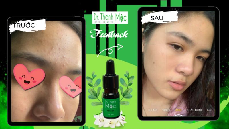 Công Dụng Của Serum Dr Thanh Mộc Trong Việc Trị Thâm Mụn