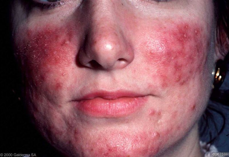 Da Nhiễm Corticoid Nặng