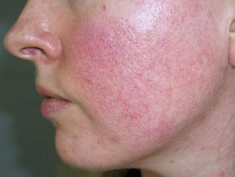 Dấu Hiệu Nhận Biết Da Nhiễm Corticoid