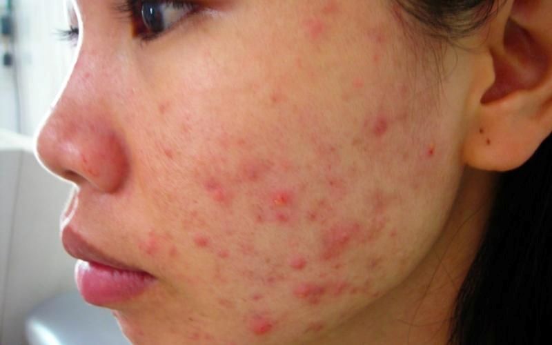 Chấm đen xuất hiện ở lỗ chân lông khi sử dụng Dr. Thanh Mộc