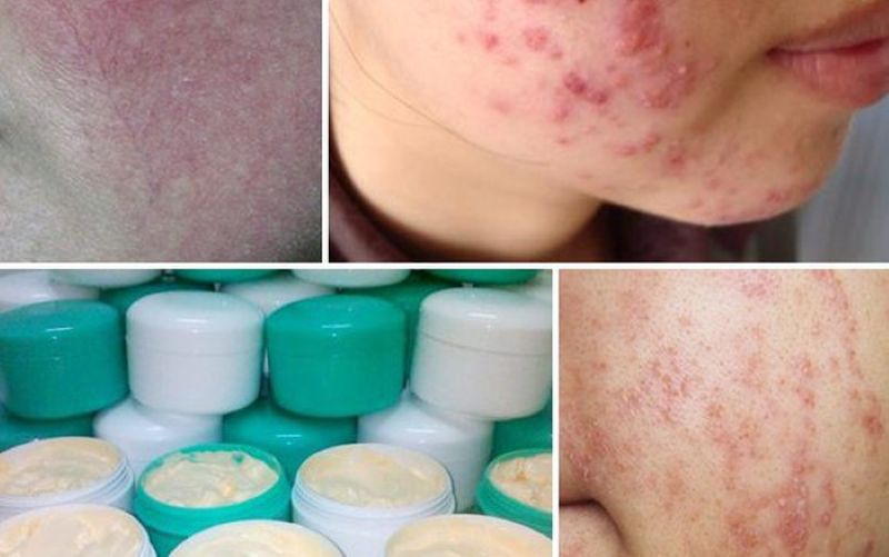 Kem Trộn và Tác Dụng Của Corticoid