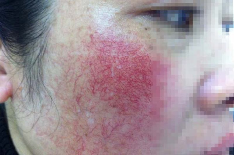 Da Nổi Mụn Khi Sử Dụng Dr Thanh Mộc
