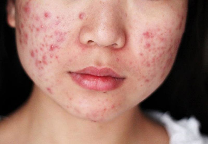 Mụn Dậy Thì: Nguyên Nhân Và Tình Trạng Thường Gặp