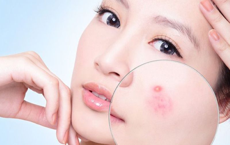 Mụn Khó Trị Do Nguyên Nhân Nào?