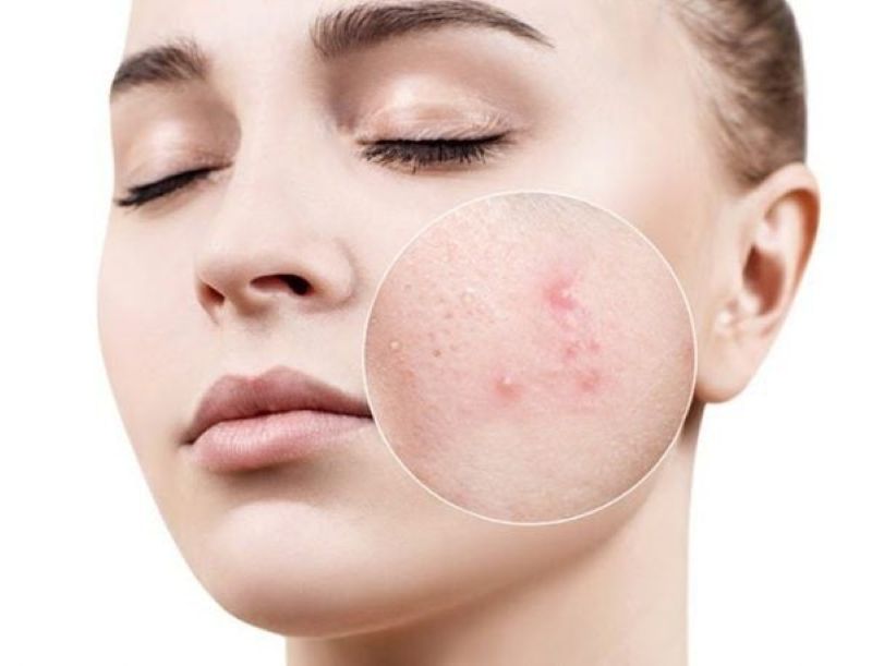 Da Phản Ứng Sau Khi Dừng Sử Dụng Các Sản Phẩm Trị Mụn Cũ