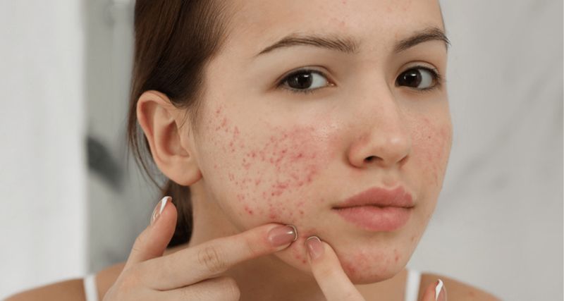 Nguyên Nhân Mụn Và Các Mức Độ Mụn Trên Da