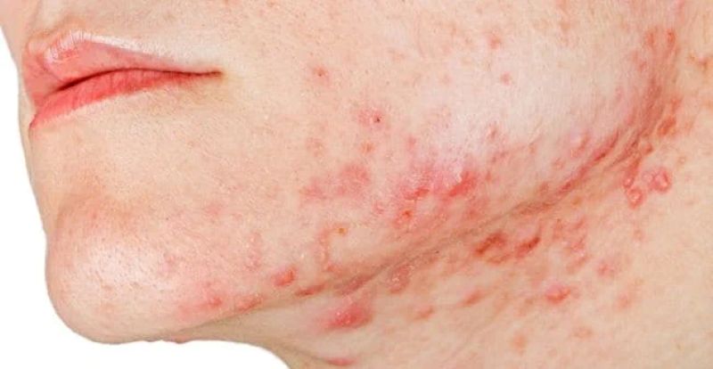 Nguyên nhân gây mụn nội tiết