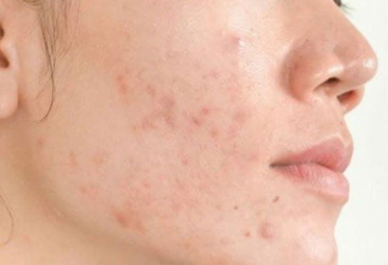 Những Lỗi Thường Gặp Khi Chăm Sóc Da Sau Khi Lấy Còi Mụn