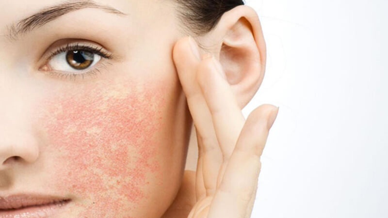 Những Lưu Ý Khi Trị Mụn Cho Da Nhiễm Corticoid
