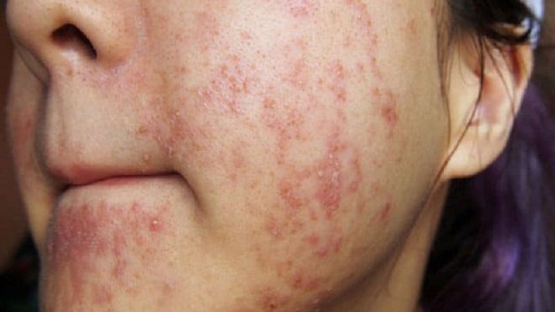 Tác Hại Của Rượu Thuốc Đối Với Làn Da