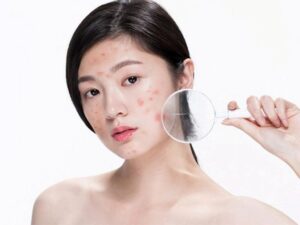 Lưu Ý Chăm Sóc Da Sau Khi Lấy Còi Mụn