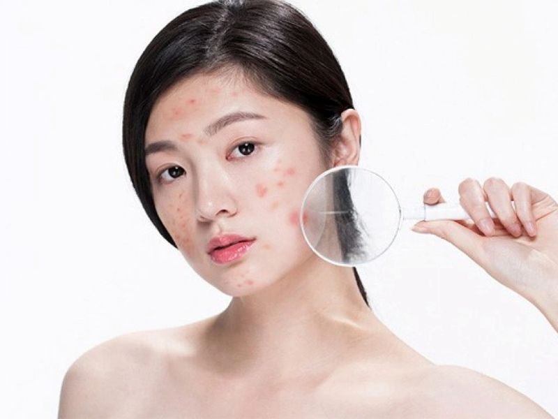 Tại Sao Cần Chăm Sóc Da Sau Khi Lấy Còi Mụn?