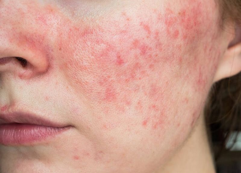 Vì sao da mỏng yếu lại gặp khó khăn khi sử dụng sản phẩm trị mụn?