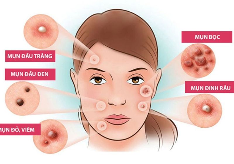 Nguyên Nhân Mụn Trên Da Và Các Mức Độ Mụn