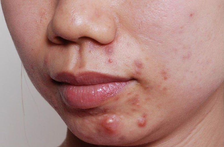 Cách trị mụn bọc không đầu hiệu quả và an toàn