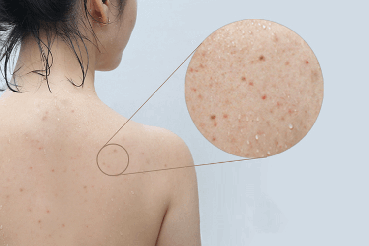 Cách trị mụn lưng hiệu quả và an toàn dễ thực hiện