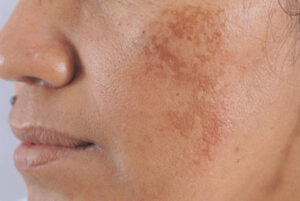 Điều trị nám bằng laser có an toàn không? Những điều cần lưu ý