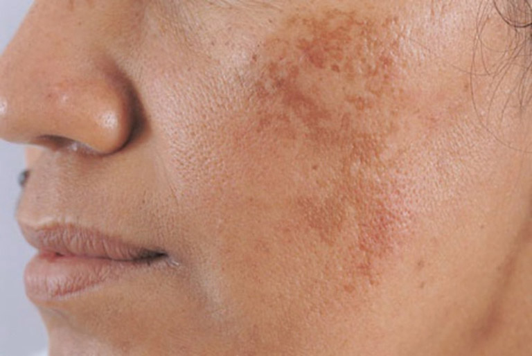 Công nghệ laser điều trị nám là gì?