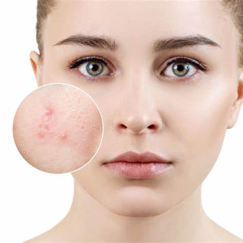 Hướng dẫn cách trị mụn bọc không đầu hiệu quả
