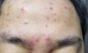 Nổi mụn ở trán: nguyên nhân, cách điều trị và phòng ngừa hiệu quả
