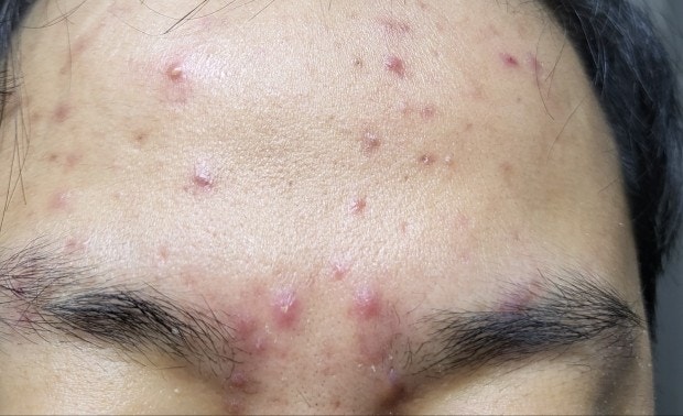 Phòng ngừa mụn ở trán