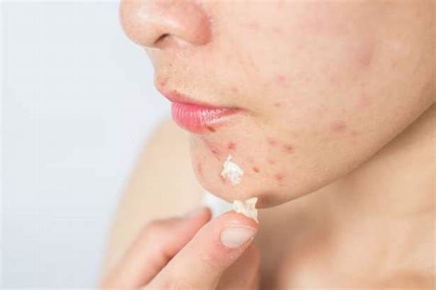 Sử dụng sản phẩm đặc trị mụn thâm đỏ